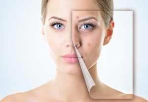 Productos antiacné sin receta: algunas consideraciones